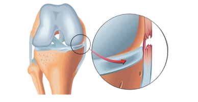 MCLR (Medial Collateral Ligament Rüptüre)