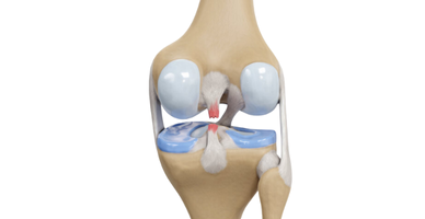 PCLR (Posterior Cruciate Ligament Rüptüre)