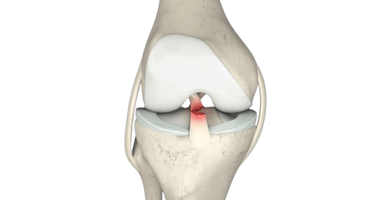 ACLR (Anterior Cruciate Ligament Rüptüre)